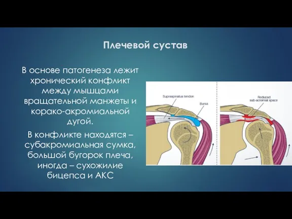 Плечевой сустав В основе патогенеза лежит хронический конфликт между мышцами вращательной манжеты