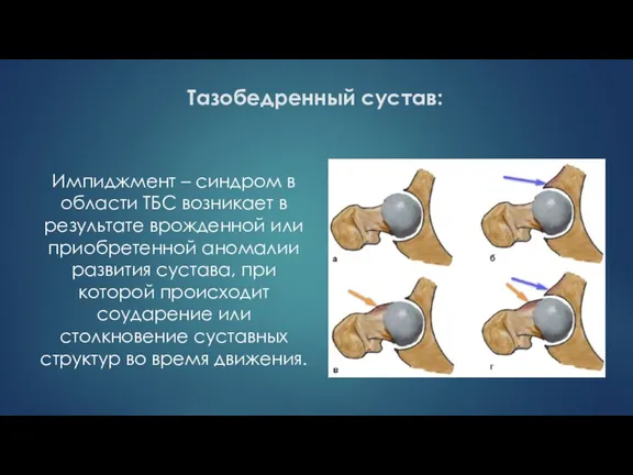 Тазобедренный сустав: Импиджмент – синдром в области ТБС возникает в результате врожденной