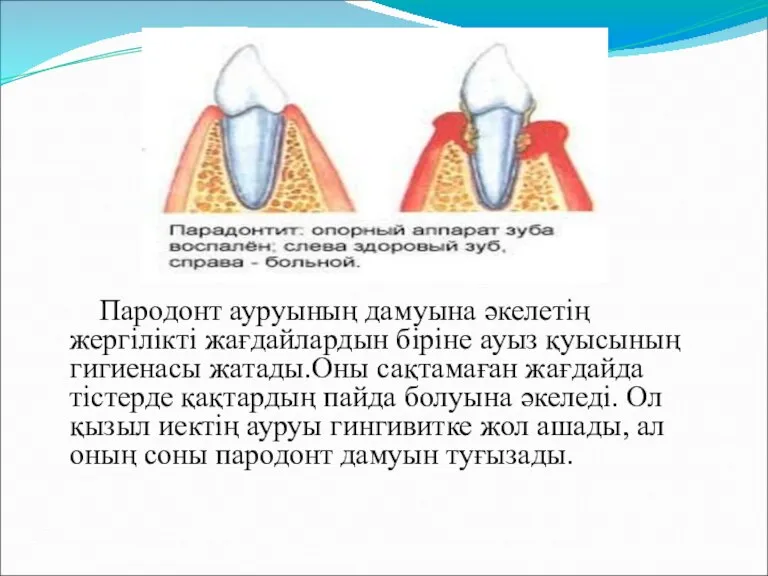 Пародонт ауруының дамуына әкелетің жергілікті жағдайлардын біріне ауыз қуысының гигиенасы жатады.Оны сақтамаған