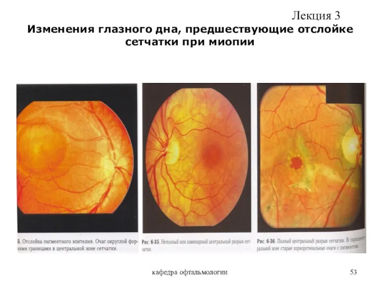 кафедра офтальмологии Изменения глазного дна, предшествующие отслойке сетчатки при миопии Лекция 3