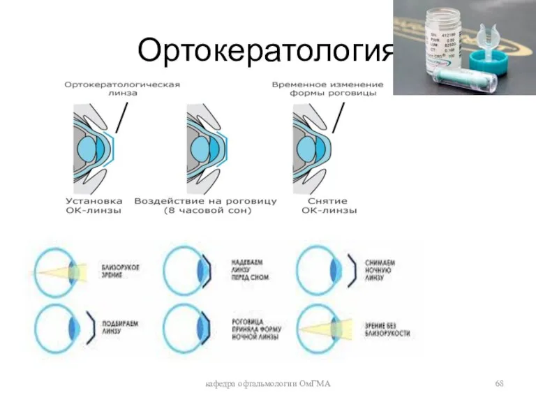 Ортокератология кафедра офтальмологии ОмГМА