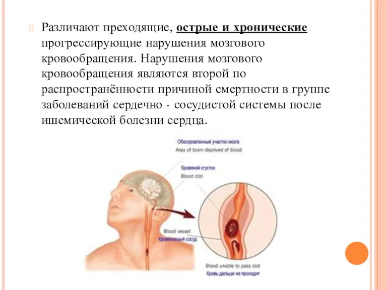 Различают преходящие, острые и хронические прогрессирующие нарушения мозгового кровообращения. Нарушения мозгового кровообращения