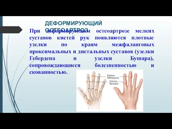 ДЕФОРМИРУЮЩИЙ ОСТЕОАРТРОЗ При деформирующем остеоартрозе мелких суставов кистей рук появляются плотные узелки