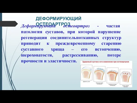 ДЕФОРМИРУЮЩИЙ ОСТЕОАРТРОЗ Деформирующий остеоартроз - частая патология суставов, при которой нарушение регенерации