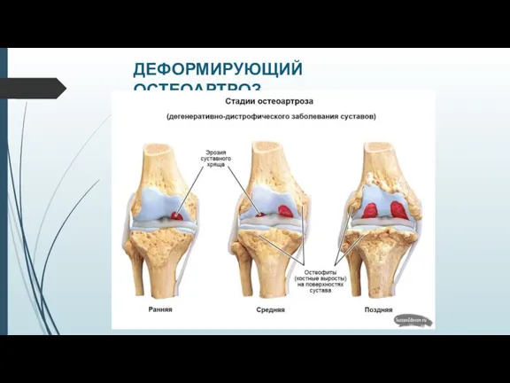 ДЕФОРМИРУЮЩИЙ ОСТЕОАРТРОЗ