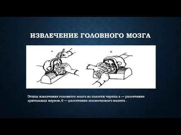 ИЗВЛЕЧЕНИЕ ГОЛОВНОГО МОЗГА Этапы извлечения головного мозга из полости черепа а —