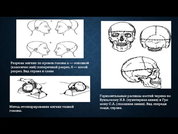 Горизонтальные рас­пилы костей черепа по Буяльскому И.В. (пунк­тирная линия) и Гро­мову С.А.