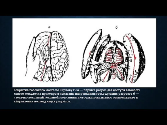 Вскрытие головного мозга по Вирхову Р.: а — первый разрез для доступа