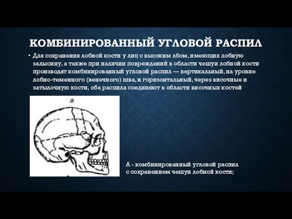 КОМБИНИРОВАННЫЙ УГЛОВОЙ РАСПИЛ Для сохранения лобной кости у лиц с высоким лбом,