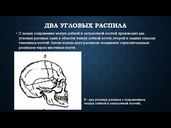 Б - два угловых распила с со­хранением чешуи лобной и затылочной костей;