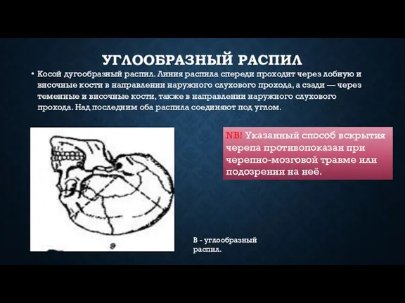 В - углообразный распил. NB! Указанный способ вскрытия черепа противопоказан при черепно-мозговой