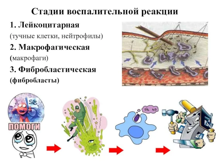Стадии воспалительной реакции 1. Лейкоцитарная (тучные клетки, нейтрофилы) 2. Макрофагическая (макрофаги) 3. Фибробластическая (фибробласты)