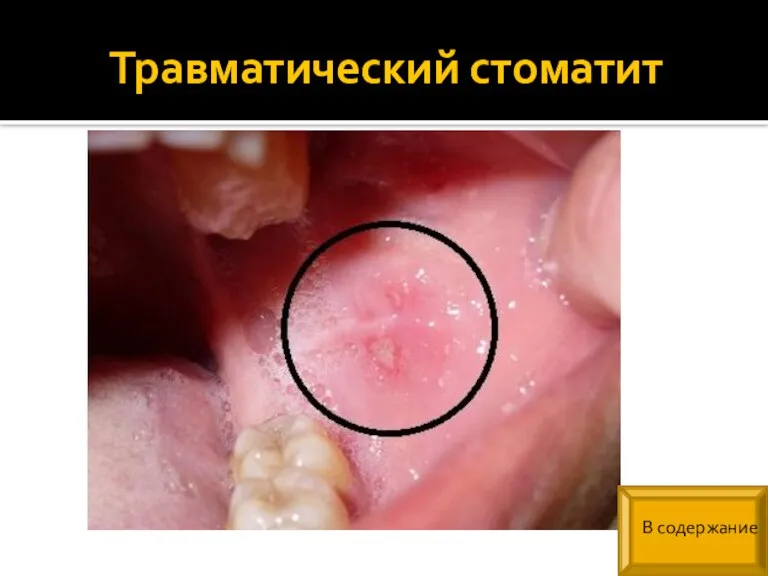 Травматический стоматит В содержание