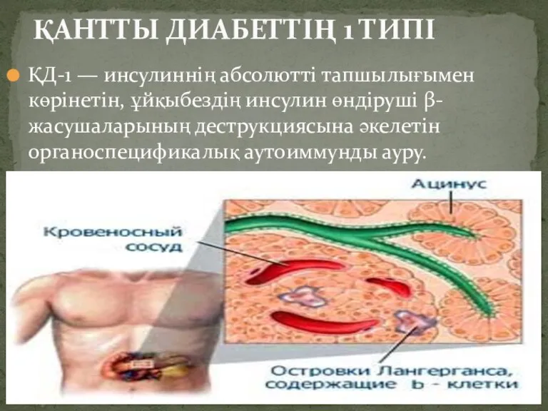 ҚД-1 — инсулиннің абсолютті тапшылығымен көрінетін, ұйқыбездің инсулин өндіруші β-жасушаларының деструкциясына әкелетін