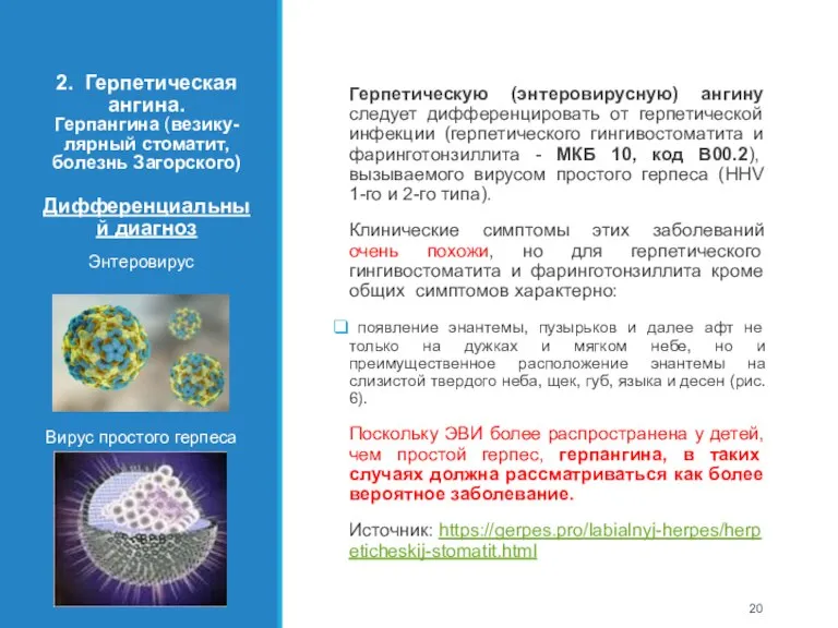 2. Герпетическая ангина. Герпангина (везику-лярный стоматит, болезнь Загорского) Дифференциальный диагноз Энтеровирус Вирус
