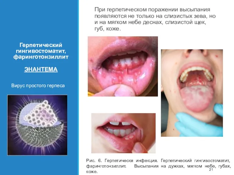 Герпетический гингивостоматит, фаринготонзиллит ЭНАНТЕМА Вирус простого герпеса РУКА При герпетическом поражении высыпания