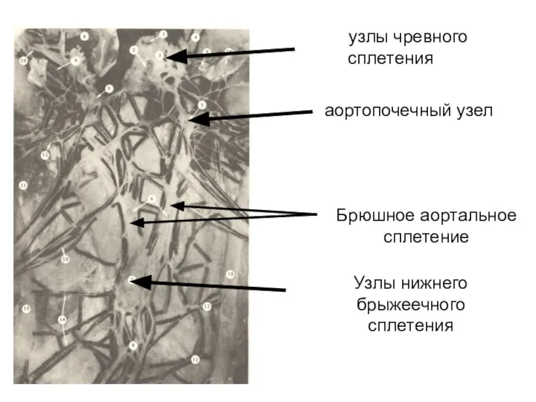 узлы чревного сплетения аортопочечный узел Брюшное аортальное сплетение Узлы нижнего брыжеечного сплетения