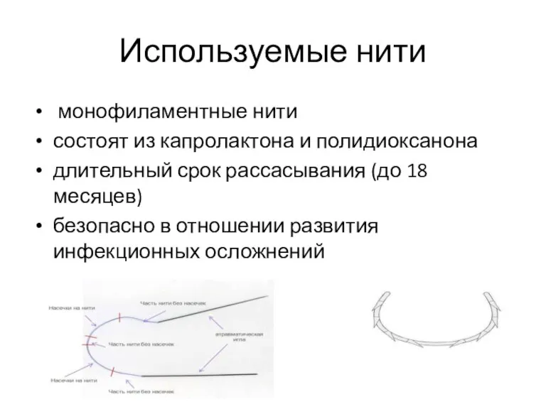 Используемые нити монофиламентные нити состоят из капролактона и полидиоксанона длительный срок рассасывания