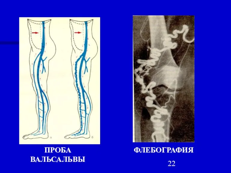 ПРОБА ВАЛЬСАЛЬВЫ ФЛЕБОГРАФИЯ