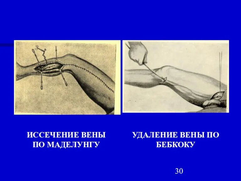 ИССЕЧЕНИЕ ВЕНЫ ПО МАДЕЛУНГУ УДАЛЕНИЕ ВЕНЫ ПО БЕБКОКУ