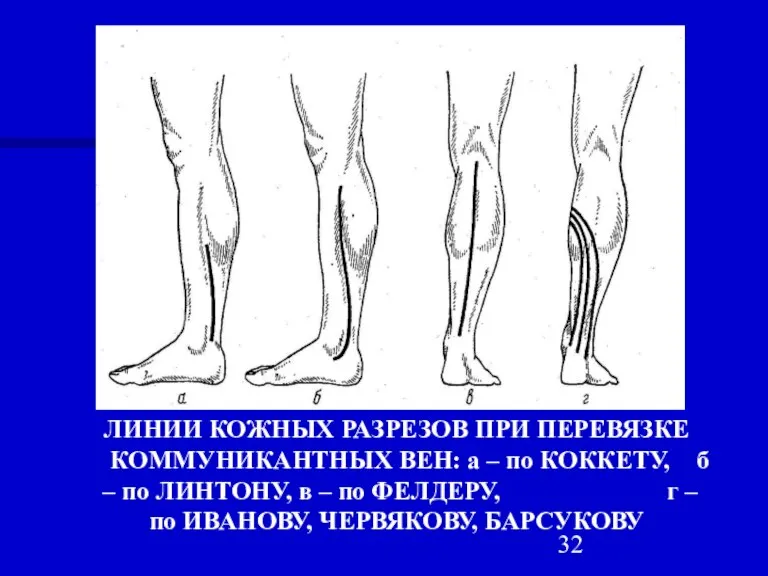 ЛИНИИ КОЖНЫХ РАЗРЕЗОВ ПРИ ПЕРЕВЯЗКЕ КОММУНИКАНТНЫХ ВЕН: а – по КОККЕТУ, б