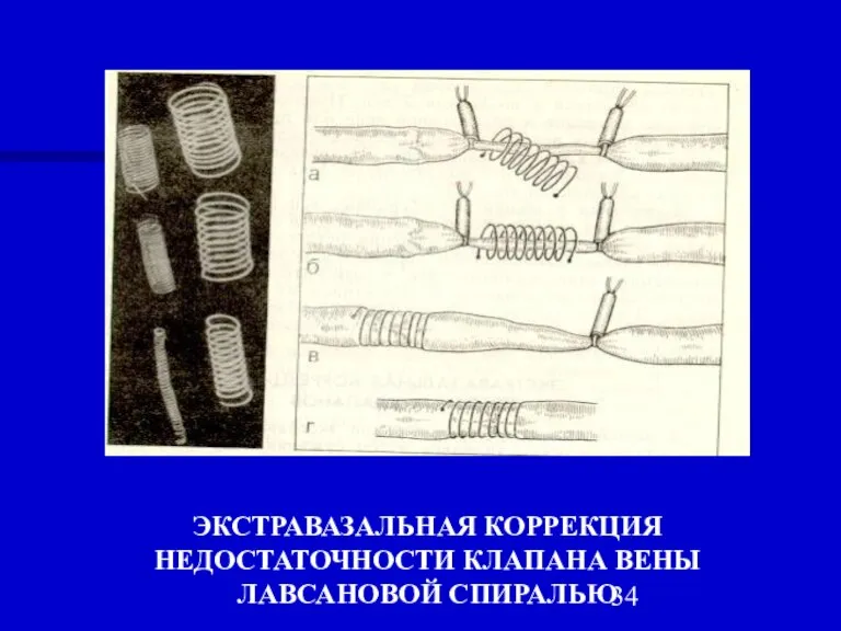 ЭКСТРАВАЗАЛЬНАЯ КОРРЕКЦИЯ НЕДОСТАТОЧНОСТИ КЛАПАНА ВЕНЫ ЛАВСАНОВОЙ СПИРАЛЬЮ