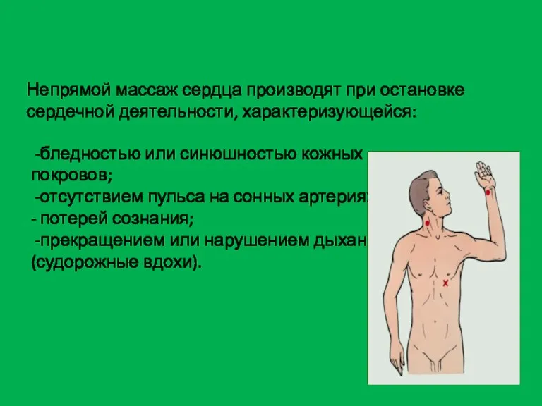 Непрямой массаж сердца Непрямой массаж сердца производят при остановке сердечной деятельности, характеризующейся: