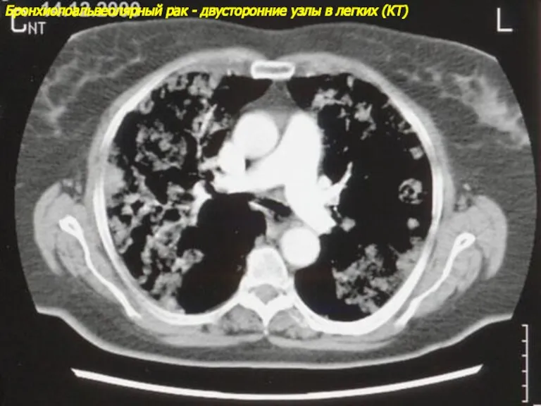 Бронхиолоальвеолярный рак - двусторонние узлы в легких (КТ)