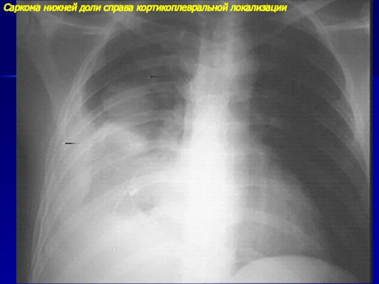 Саркома нижней доли справа кортикоплевральной локализации