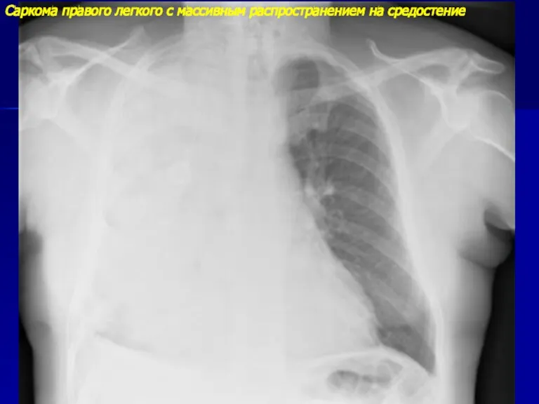 Саркома правого легкого с массивным распространением на средостение