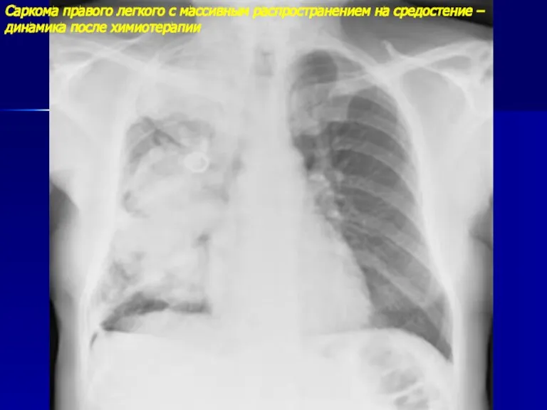 Саркома правого легкого с массивным распространением на средостение – динамика после химиотерапии