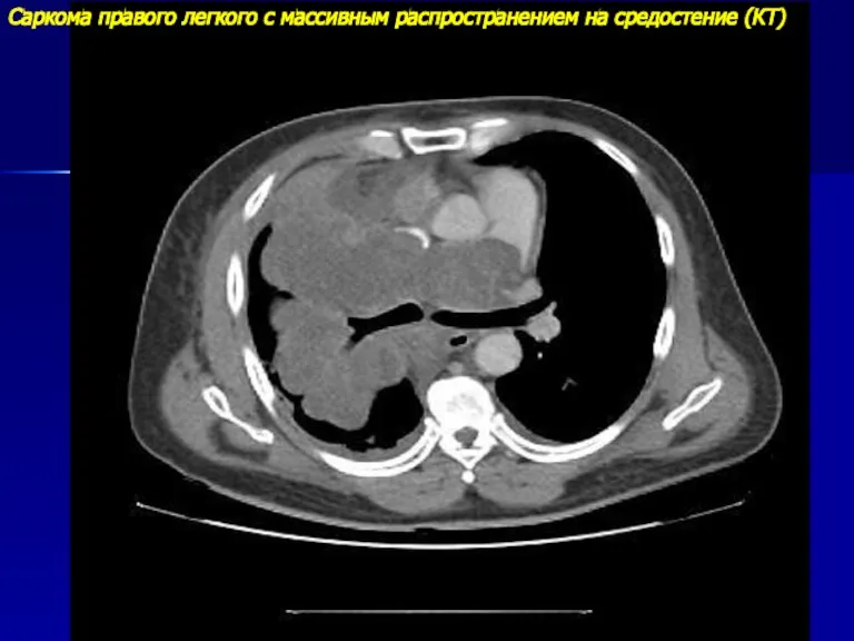 Саркома правого легкого с массивным распространением на средостение (КТ)