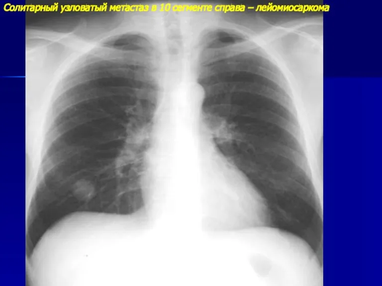 Солитарный узловатый метастаз в 10 сегменте справа – лейомиосаркома