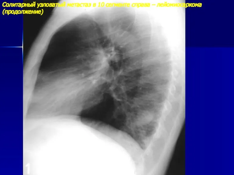 Солитарный узловатый метастаз в 10 сегменте справа – лейомиосаркома (продолжение)