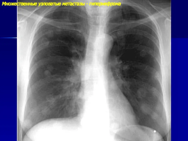Множественные узловатые метастазы - гипернефрома