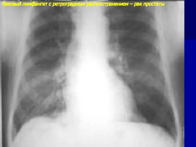 Раковый лимфангит с ретроградным распространением – рак простаты