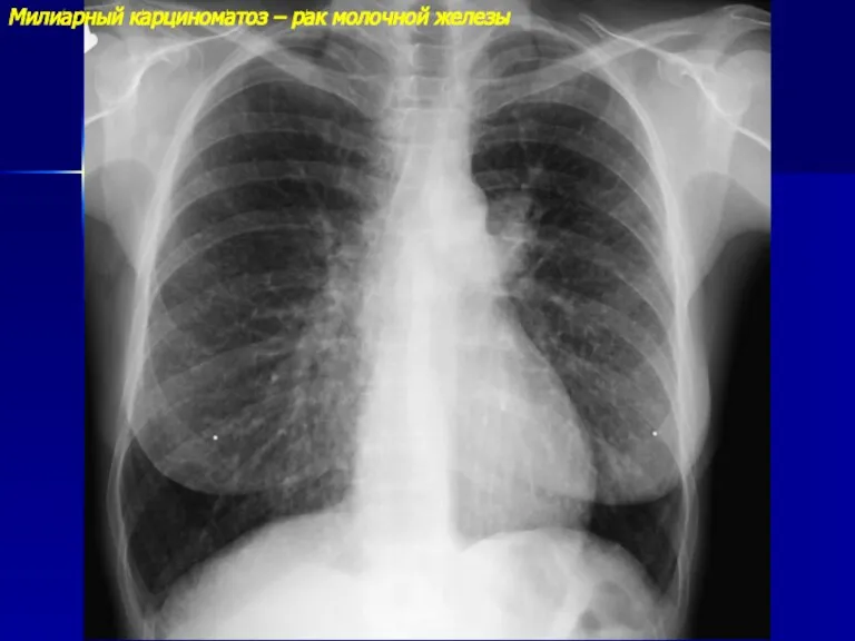 Милиарный карциноматоз – рак молочной железы