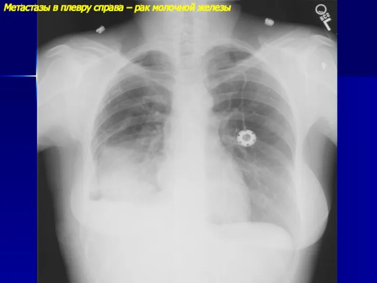 Метастазы в плевру справа – рак молочной железы