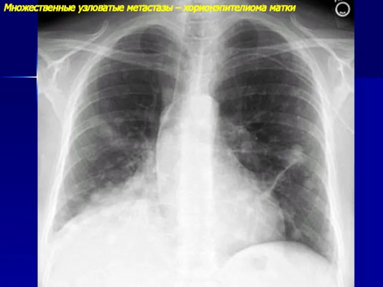 Множественные узловатые метастазы – хорионэпителиома матки