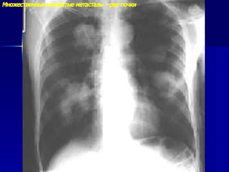 Множественные узловатые метастазы – рак почки