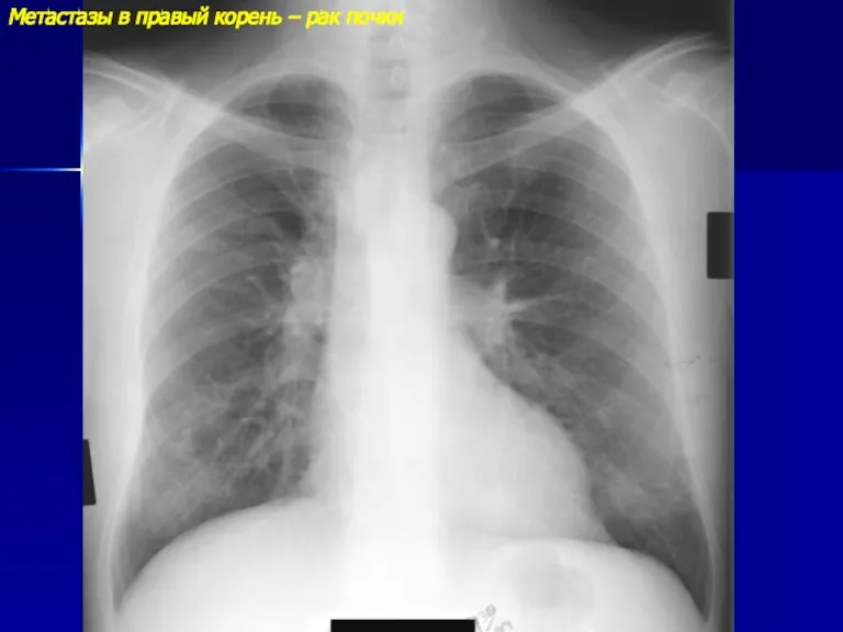 Метастазы в правый корень – рак почки