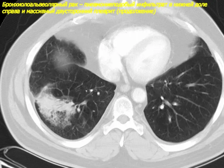 Бронхиолоальвеолярный рак – пневмониеподобый инфильтрат в нижней доле справа и массивный двусторонний плеврит (продолжение)