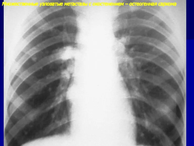 Множественные узловатые метастазы с окостенением – остеогенная саркома