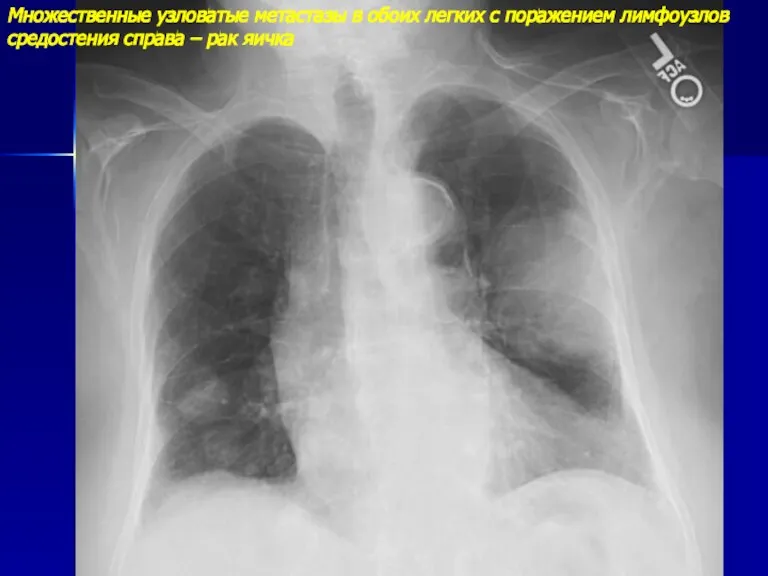 Множественные узловатые метастазы в обоих легких с поражением лимфоузлов средостения справа – рак яичка