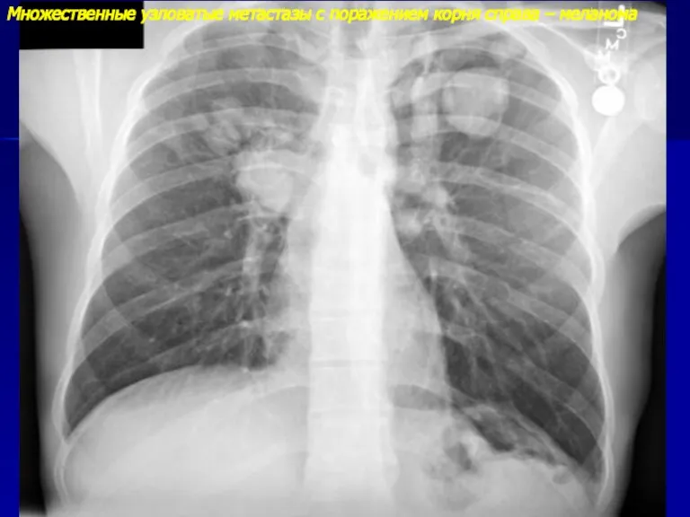 Множественные узловатые метастазы с поражением корня справа – меланома