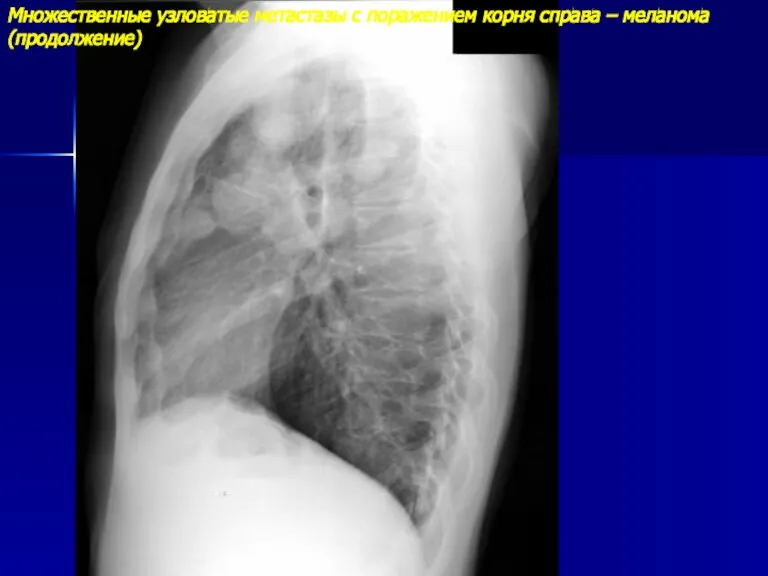 Множественные узловатые метастазы с поражением корня справа – меланома (продолжение)