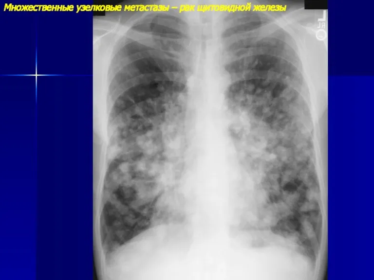 Множественные узелковые метастазы – рак щитовидной железы