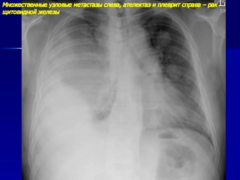 Множественные узловые метастазы слева, ателектаз и плеврит справа – рак щитовидной железы