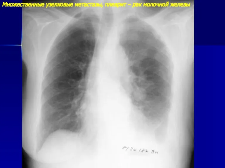 Множественные узелковые метастазы, плеврит – рак молочной железы