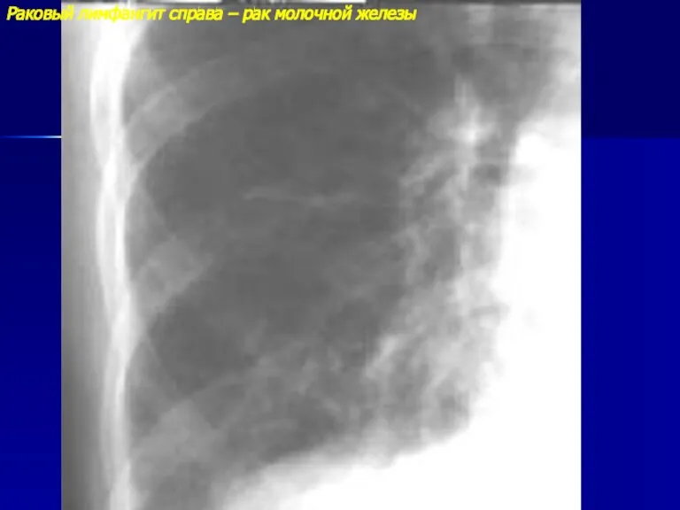 Раковый лимфангит справа – рак молочной железы